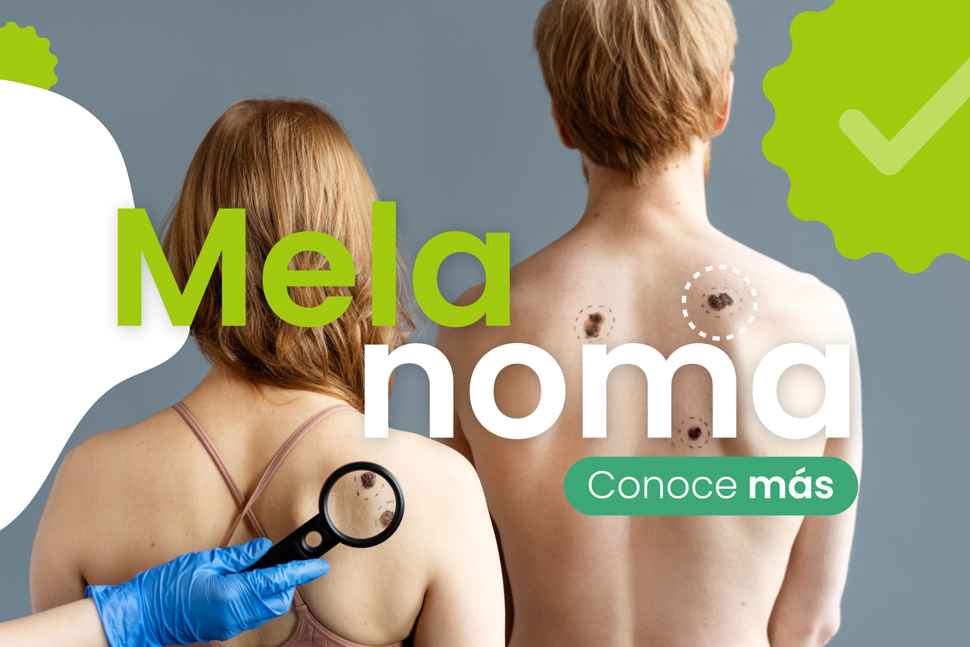Melanoma
